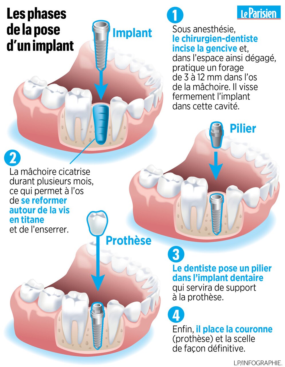 Prix Implant Dentaire Tout Ce Qu Il Faut Savoir Sur Le Prix Des Implants Hot Sex Picture 